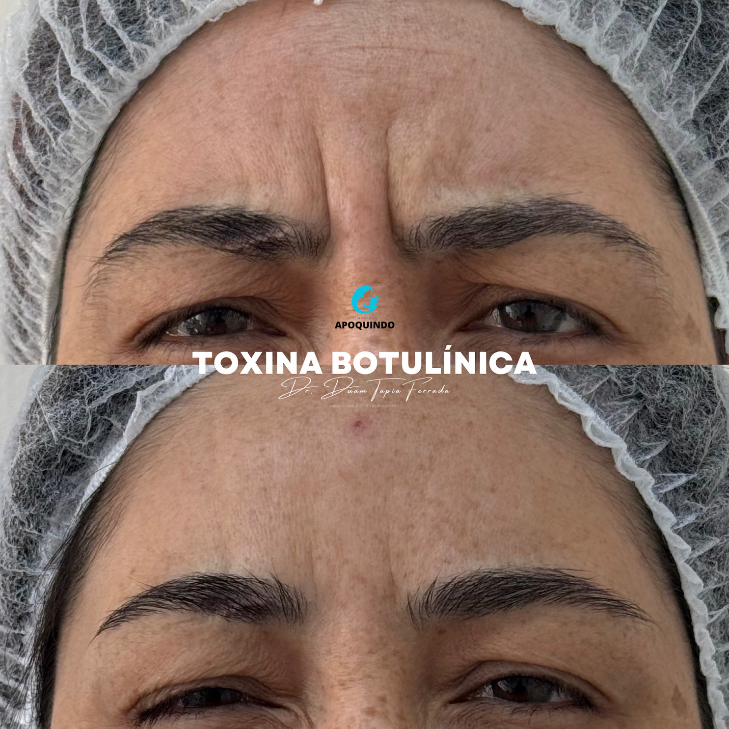 Antes botox