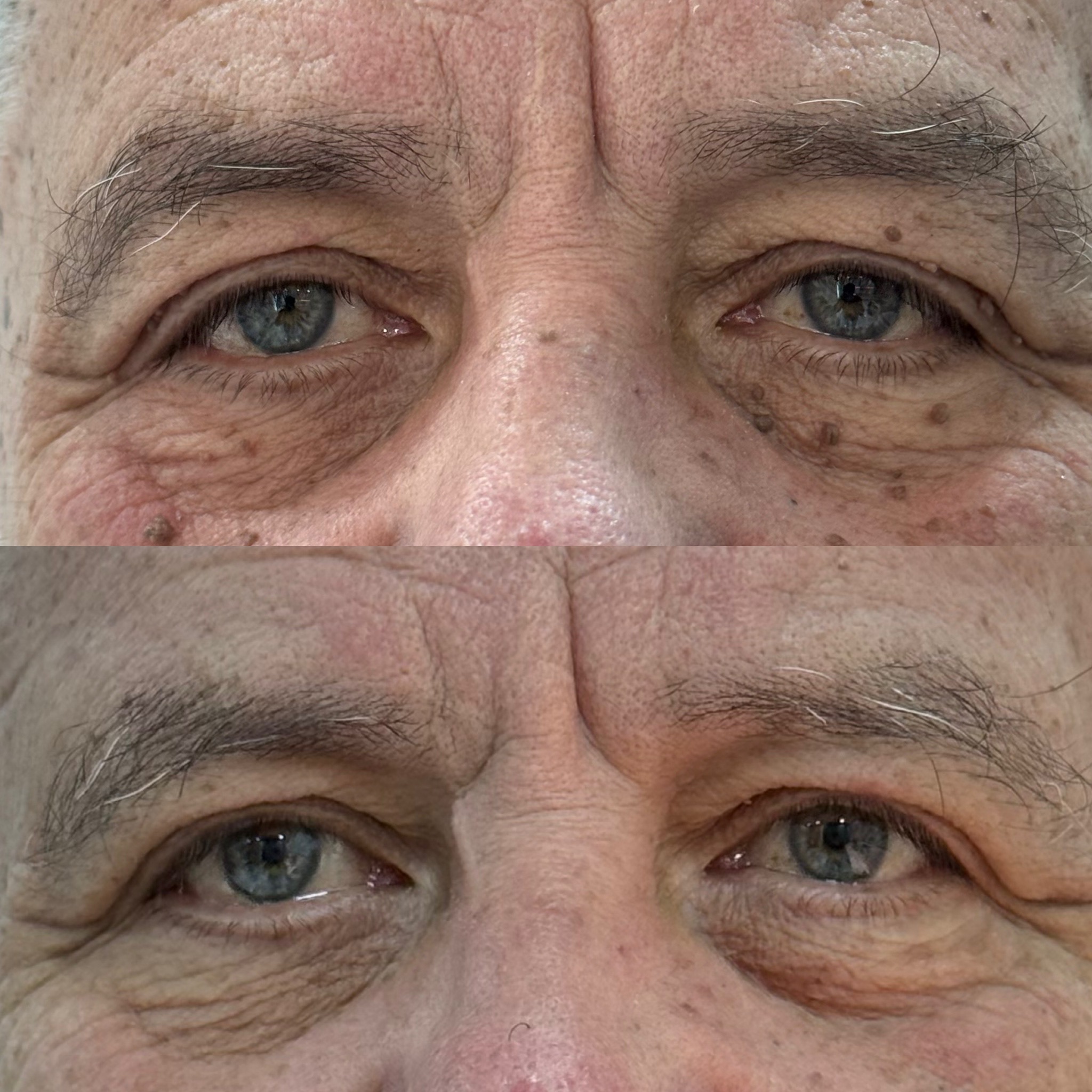 Extirpación de Lunares